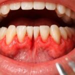 découvrez les causes et symptômes du dédoublement des gencives pour mieux comprendre cette condition bucco-dentaire et savoir quand consulter un professionnel.